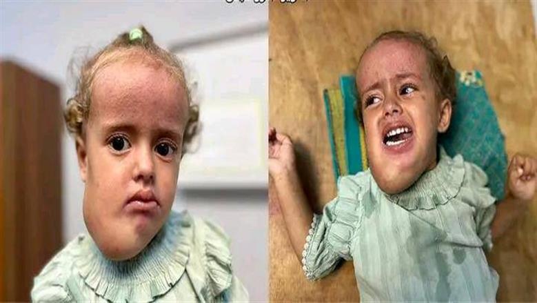 ورم نادر يحرم الفلسطينية «جوليا» من الاستمتاع بطفولتها.. تحتاج لتدخل جراحي عاجل