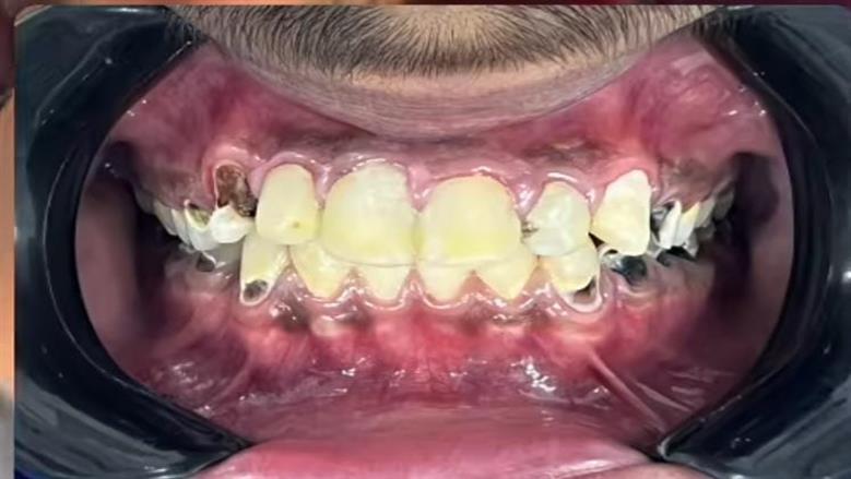  مشروب شهير يدمر أسنان شاب مصري عمره 17 عاما.. ما مخاطر الحمضيات؟