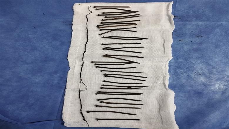  «بلعت 34 مسمار».. الطب النفسي يكشف أسباب الحالة بعد إنقاذ سيدة في كفر الشيخ