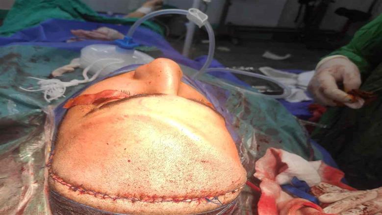 نجاح 18 جراحة معقّدة للوجه والفكين و131 حالة أطفال تحت التخدير بالمنوفية