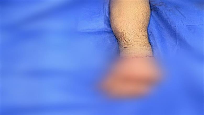 إعادة اليد المبتورة