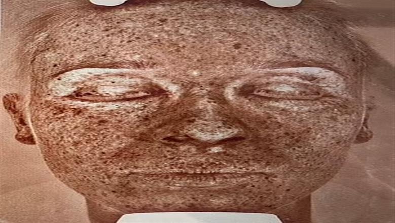 مخاطر التعرض لأشعة الشمس والضوء الأزرق