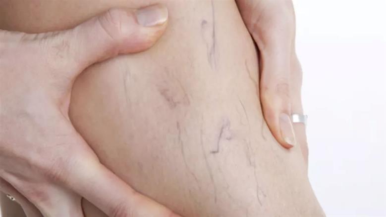 3 طرق فعالة لعلاج الدوالي بدون جراحة.. تعرف على أحدث التقنيات