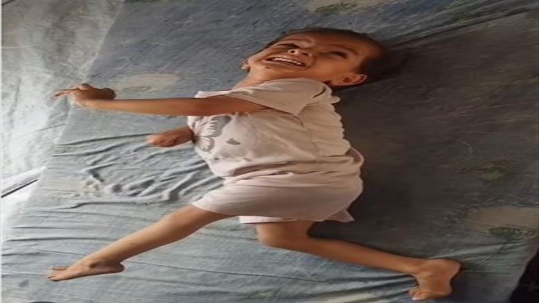في حضن الألم.. الطفلة الفلسطينية نايا أبو ريدة تُصارع الموت بصمت