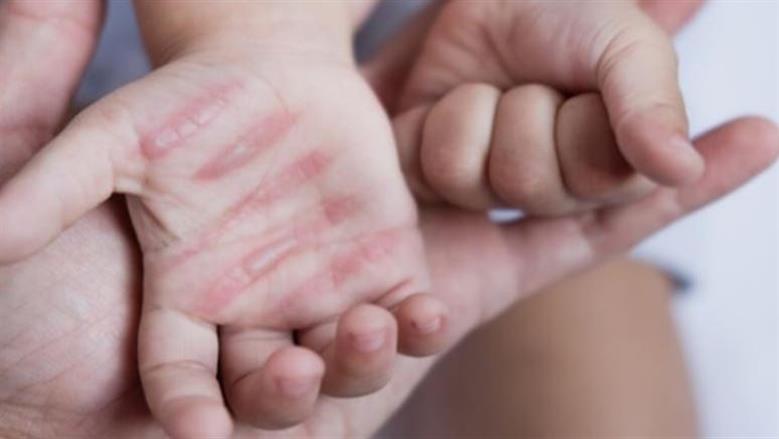 حلول فعالة لعلاج حروق المطبخ.. «قبل ما تسيب علامة»