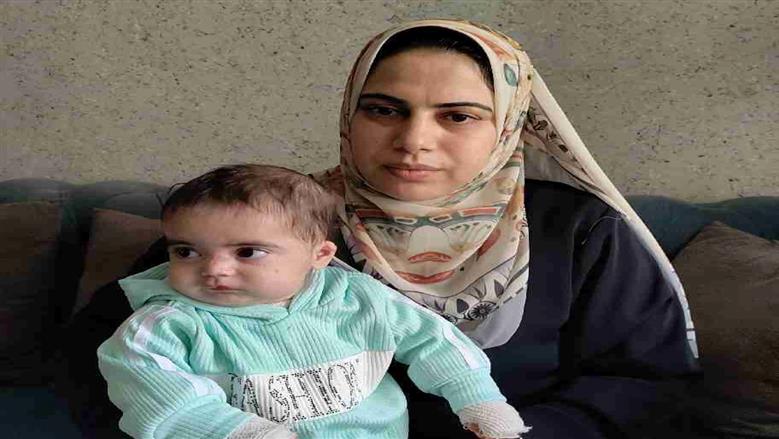 تمارا طفلة بلا جلد منذ ميلادها.. والدتها: المرض يأكل جسدها  وتحتاج لـ600 جنيه يوميا