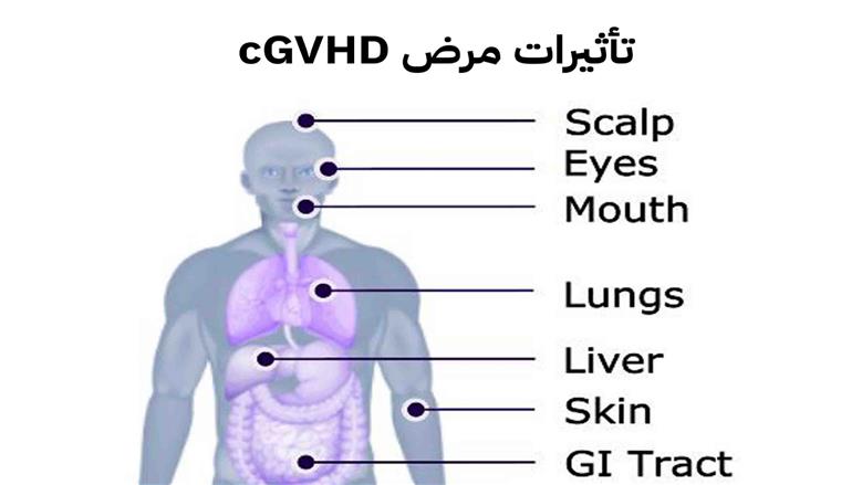 ما بعد زراعة النخاع العظمي؟ .. في ضوء اليوم العالمي لمرضى الطرد العكسي ضد النخاع