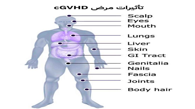 ما بعد زراعة النخاع العظمي؟ .. في ضوء اليوم العالمي لمرضى الطرد العكسي ضد النخاع