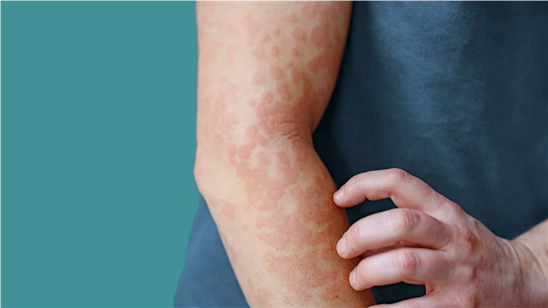 ما هي حساسية الأرتكاريا؟.. أبرز الأسباب ووسائل العلاج