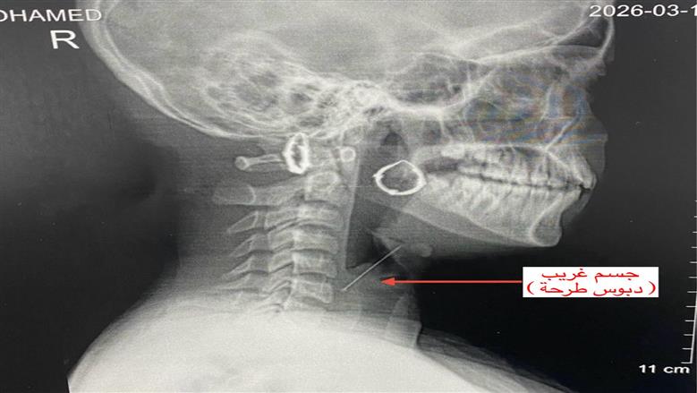 في عملية دقيقة.مستشفيات جامعة بنها تنجح في استخراج دبوس طرحة عالق بحنجرة فتاة