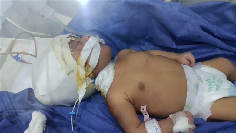 نجاح فريق طبي في إجراء أول عملية لتركيب ضمام مخ خارجي لطفل بالدقهلية  