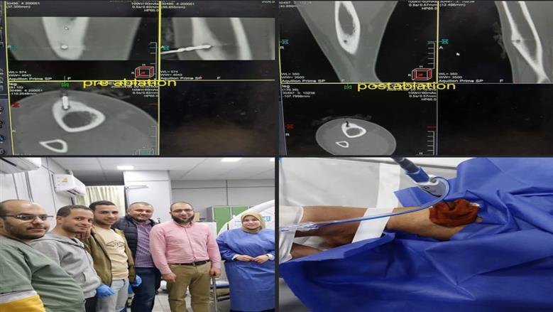 نجاح عملية كي حراري لعلاج ورم عظمي بمستشفيات جامعة بني سويف
