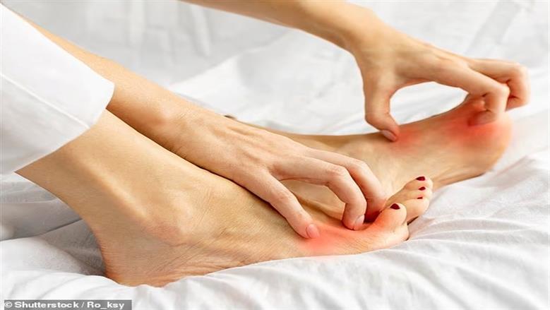 ماذا تعرف عن وباء «قدم الرياضي»؟.. عدوى فطرية تصيب الملايين حول العالم