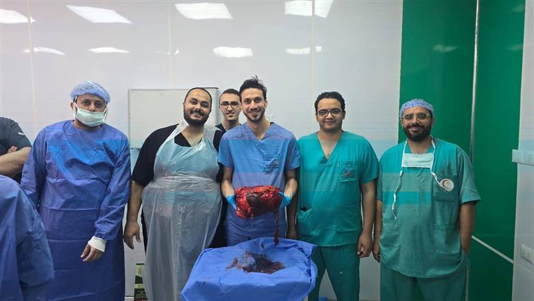 استئصال ورم نادر يزن 30 كيلو جراما من بطن مريض بالمنوفية