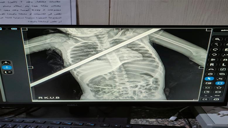 معجزة طبية في بنها.. إنقاذ طفلة اخترق سيخ حديدي صدرها من الموت 