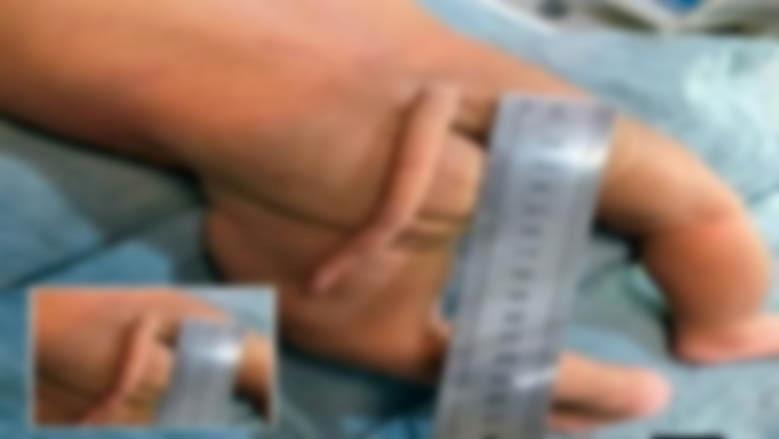 ولادة طفل بذيل في كولومبيا.. حالة طبية نادرة تثير الاهتمام