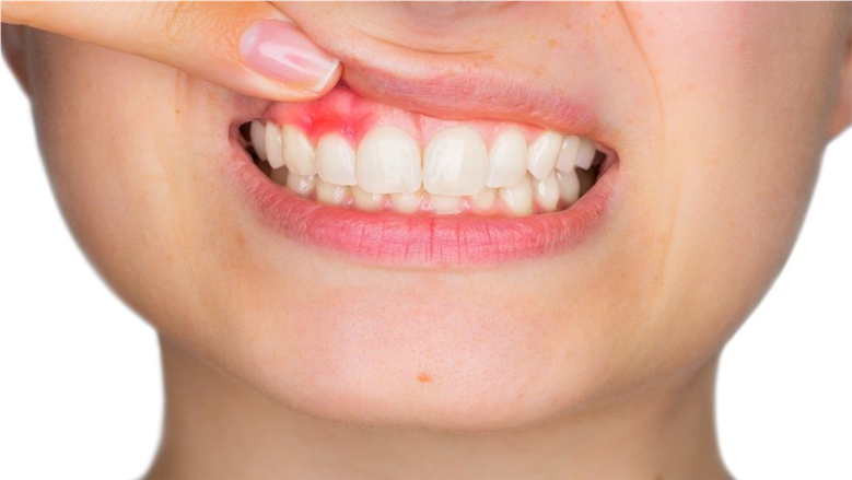 خطر صامت يهدد ابتسامتك.. ما لا تعرفه عن مشكلة وأسباب انحسار اللثة