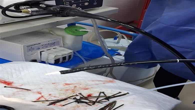 استخراج 100 مسمار وصامولة من معدة مريض دون جراحة بمستشفى جامعة بني سويف دون جراحة