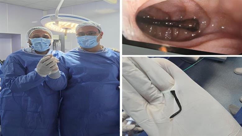 استخراج مسمار طوله 5 سنتيمترات من الأمعاء الدقيقة لطفل بالشرقية 