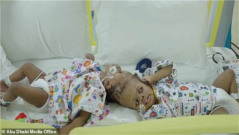 فصل توأم ملتصق من الرأس بمساعدة الذكاء الاصطناعي.. جراحة نادرة لمدة 12 ساعة