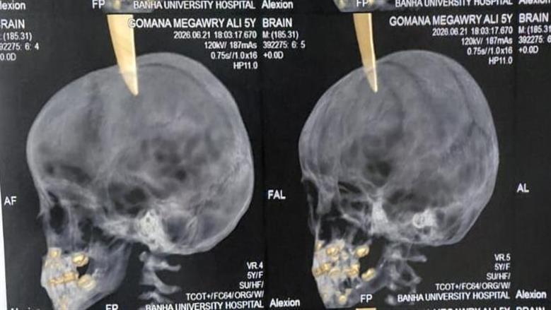 إنجاز طبي استثنائي في جراحه عاجلة ودقيقه تنقذ حياة طفلة 5 سنوات لأول مره بمستشفيات جامعة بنها