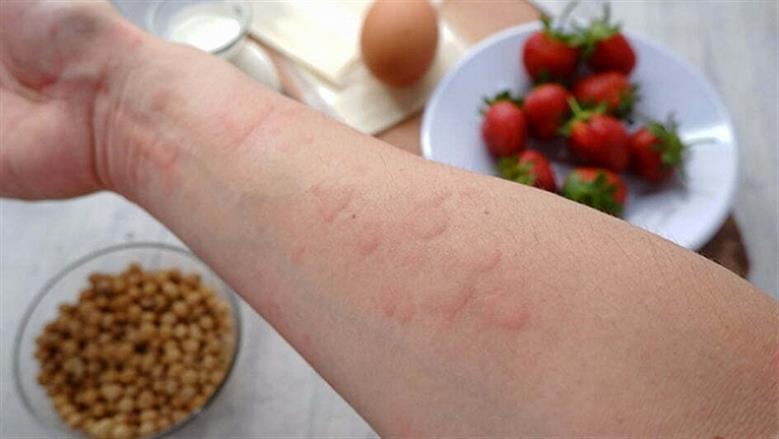 ما علاقة حساسية الطعام بالجهاز المناعي؟.. نصائح لتجنب النوبات للمصابين