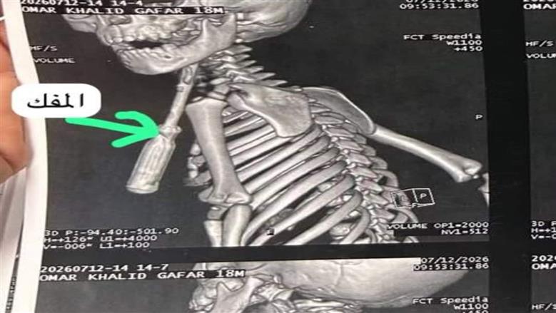 إنقاذ حياة طفل بجراحة عاجلة في مستشفي بنها الجامعي