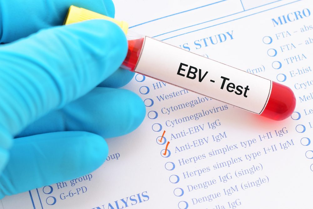 فيروس EBV
