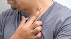 هل الزوائد الجلدية تسبب أمراضا خطيرة؟.. احذر الطرق الخاطئة لإزالتها