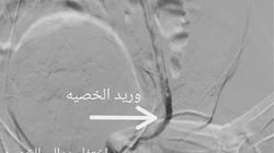 «جامعي سوهاج» يعلن نجاح أول قسطرة لعلاج «دوالي الخصية» بدون جراحة