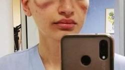أصابت أطباء إيطاليا.. متى تتسبب الأقنعة في ظهور علامات تشبه الكدمات؟