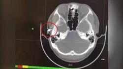 رصاصة تسكن رأس شاب لمدة 20 عاما ولم يعرف أهله بها.. «خاف لأبوه يزعقله»