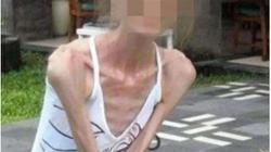 امرأة مهووسة بالنحافة وصل وزنها لـ25 كيلو جراما.. «جربت كل الطرق عشان تخس»