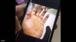 شوكة سمكة تهدد صينيا ببتر يده