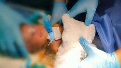 لأول مرة.. إجراء جراحة شق حنجري لطفل عمره 54 يوما بالسويس