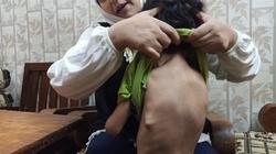 «جسمه بيتحول لعضم لو اتخبط».. متلازمة «الرجل الصخرة» تحرم «محمد» من طفولته