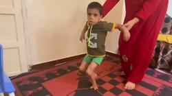 تشوه نادر يصيب الطفل «مالك».. قدماه بـ3 أصابع: نفسه يمشي
