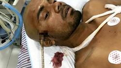 بالصور| بعد ساعة ونصف.. أطباء يخرجون سيخ حديد من جمجمة هندي