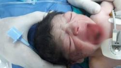 مستشفى مدينة نصر للتأمين الصحي يجري جراحة نادرة لطفل حديث الولادة