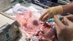 بالفيديو| تحدث مرة كل 126 ألف حالة.. ولادة طفلة بقلب خارج جسدها