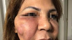 حقنة «فيلر» في عيادة طبيبة تجميل تشوه وجه «مها» وابنتها تحذر السيدات