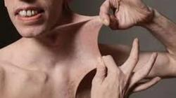 متلازمة إهلرس دانلوس.. قدرة خارقة أم مرض خطير؟