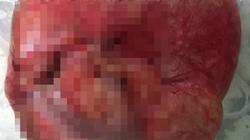 استئصال ورم يزن نحو 3 كيلو من رحم سيدة بالأقصر