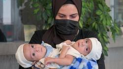 9 معلومات عن عملية التوأم السيامي العراقي «علي وعمر» بالسعودية (فيديو)