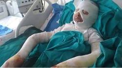 لعلاج "القمل".. مراهقة تركية تحرق نفسها بـ"البنزين"