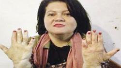 مبادرة لاحتواء مصابى الحروق: من حقنا نفرح ونعيش