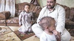"الأنيميا المنجلية"  مرض مزمن  يهدد الأطفال