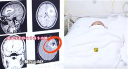 واقعة طبية غريبة بالصيني.. شابة تفقد لغتها الإنجليزية وتستعيدها بـ«حل جراحي»