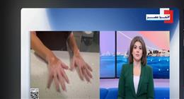 70 مليون مصاب عالميا.. هل العامل النفسي يعالج البهاق ؟
