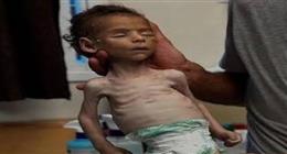 مدير «الإغاثة الطبية» بغزة: أكثر من 650 ألف طفل بالقطاع يعانون من مجاعة حقيقية 